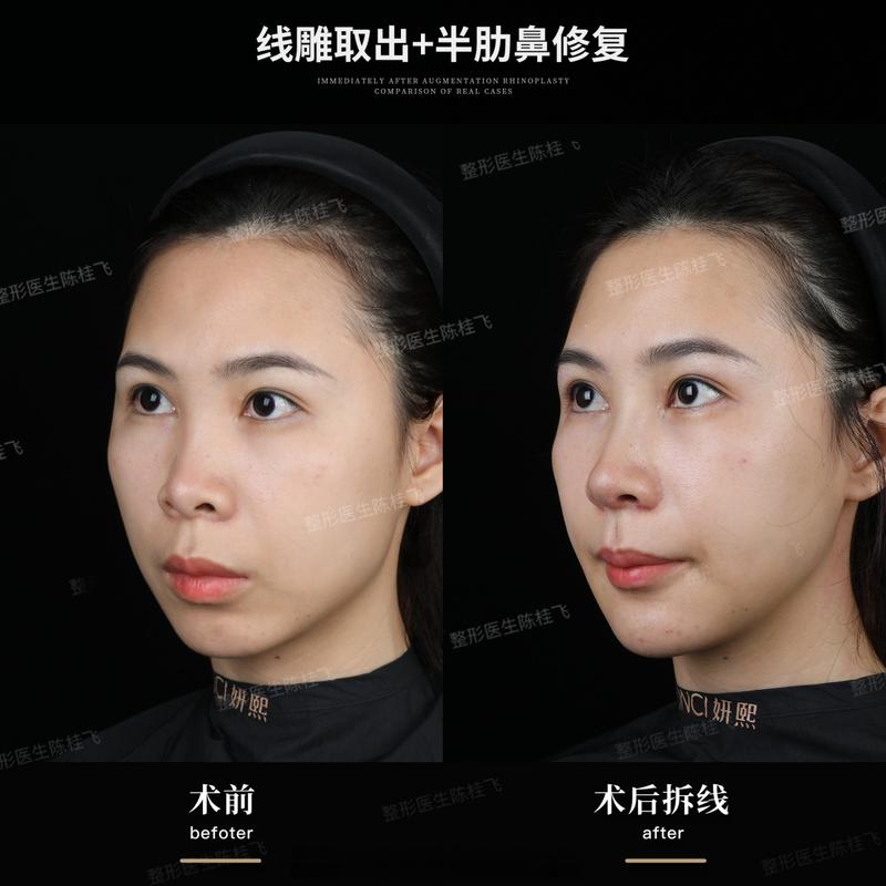 线雕隆鼻是什么