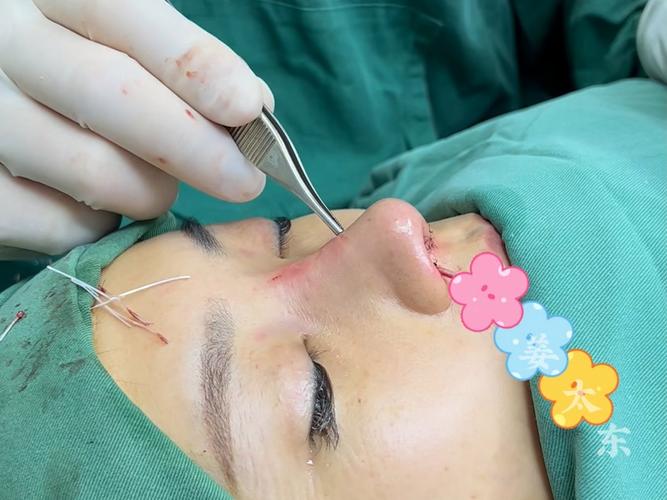 线雕隆鼻是什么