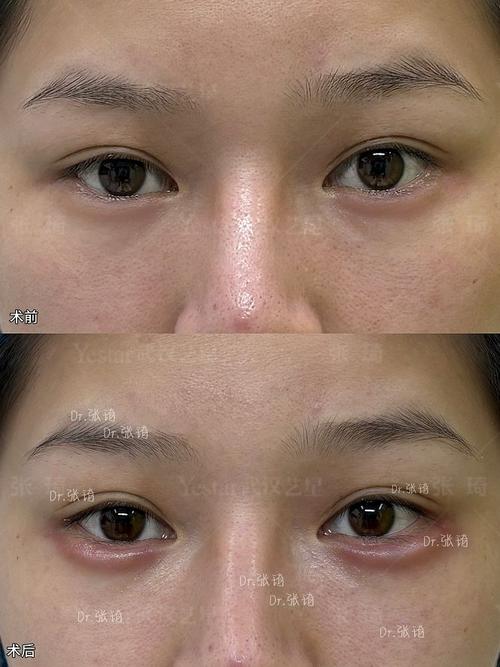 线雕隆鼻是什么