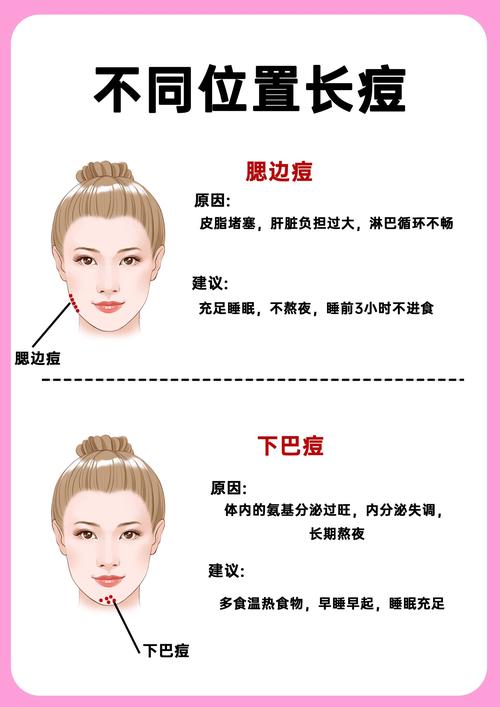 为什么脸上总长痘