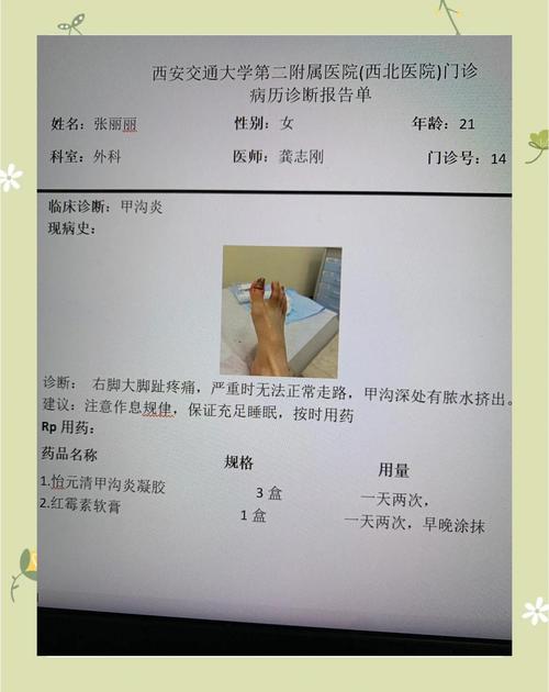 甲沟炎去什么科