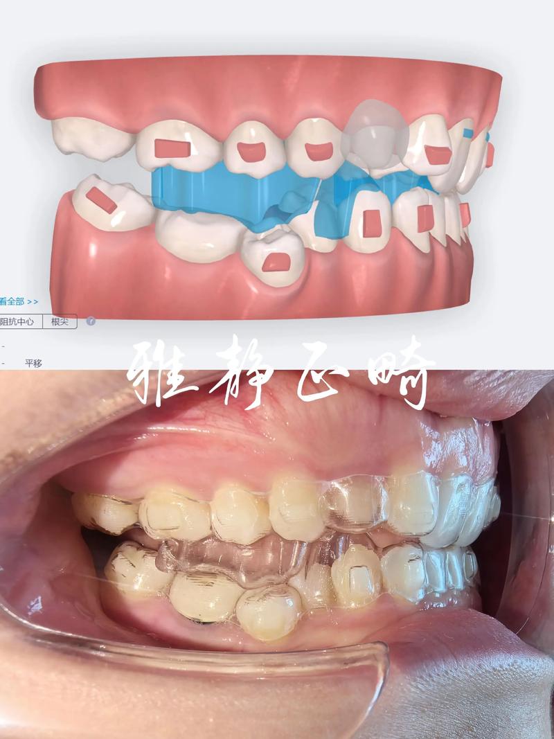 什么是隐形矫正