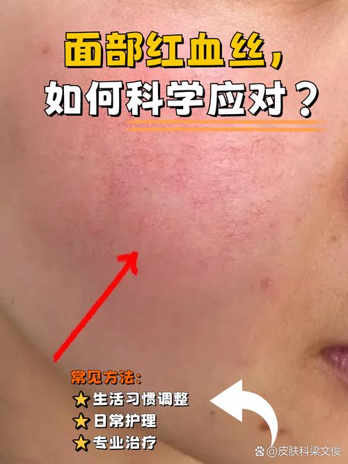 为什么会长红血丝