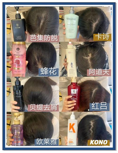 什么洗发水治脱发
