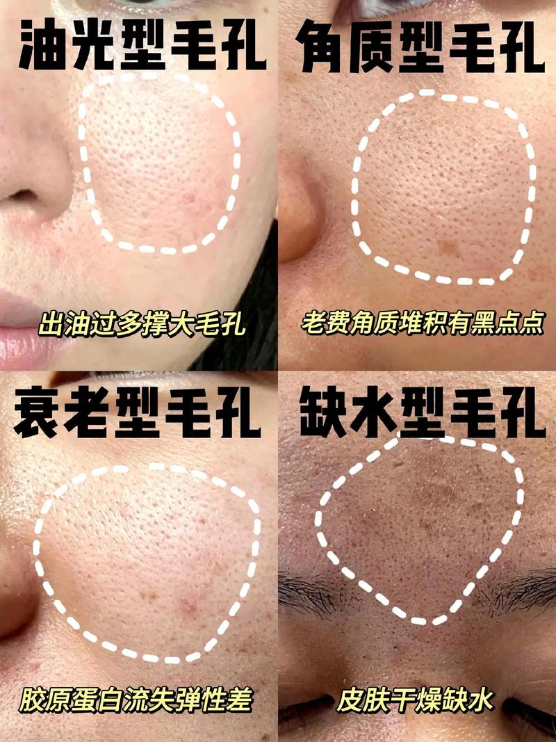 毛孔粗大是为什么