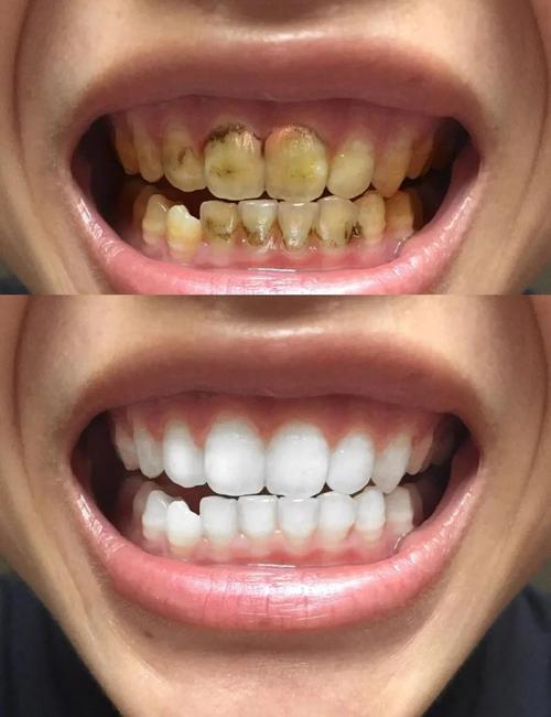 吃什么牙齿会变白