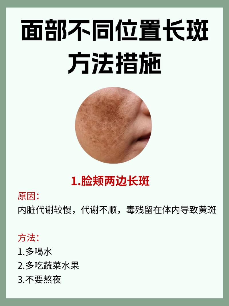 脸颊长斑是什么原因