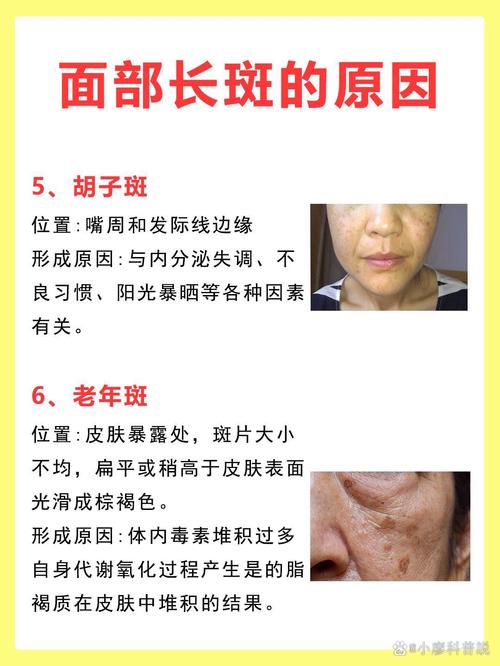 脸上为什么会长斑点