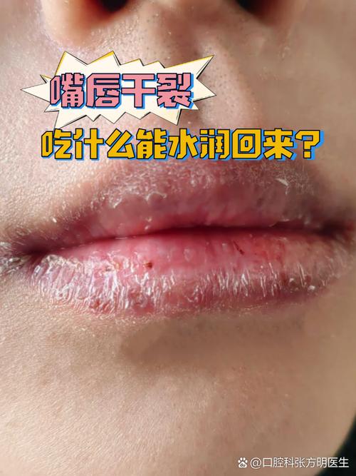 嘴唇干裂是缺什么