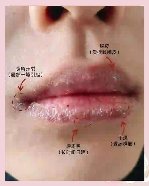 嘴唇干裂是缺什么
