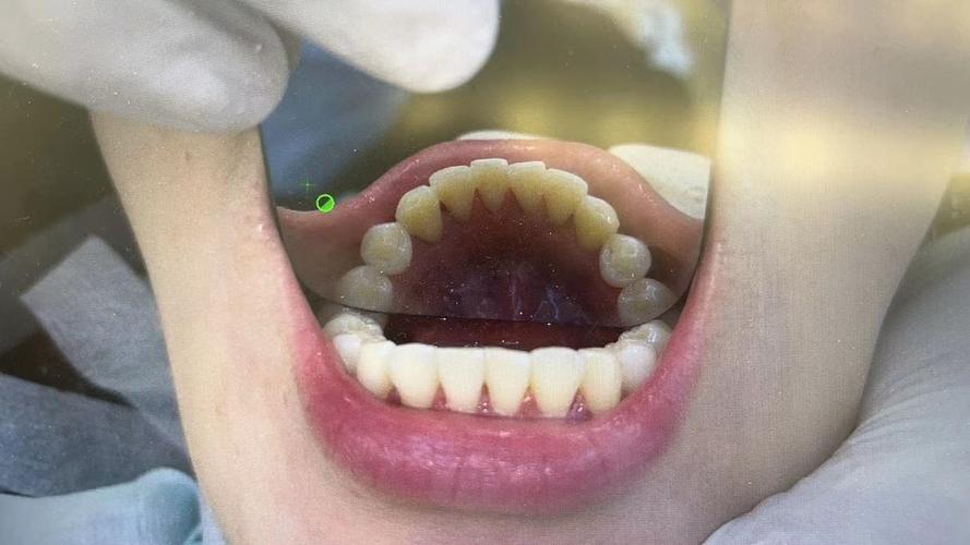 洗牙是什么感觉