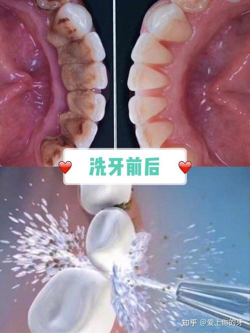 洗牙是什么感觉