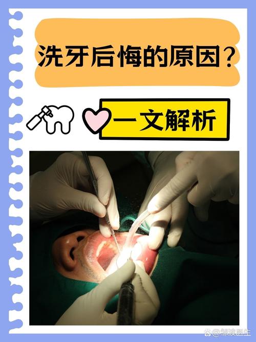 洗牙是什么感觉