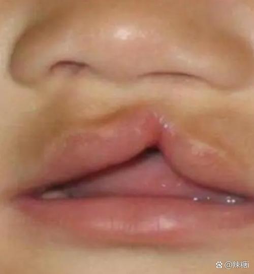 为什么会有兔唇