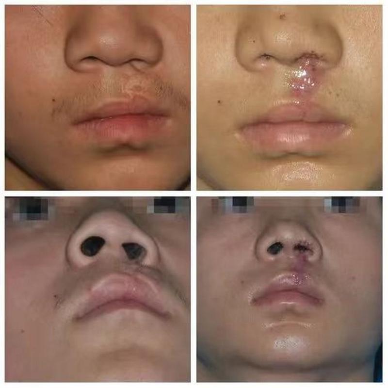 为什么会有兔唇