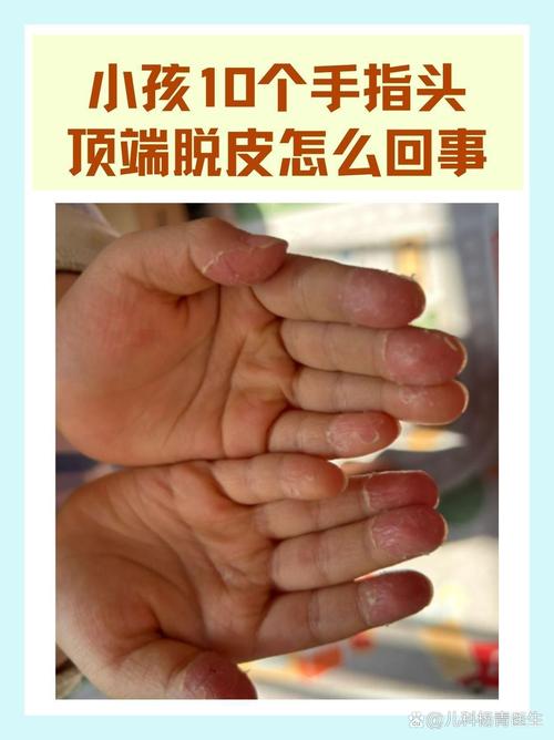 手指头为什么会脱皮