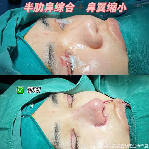 鼻综合是什么意思