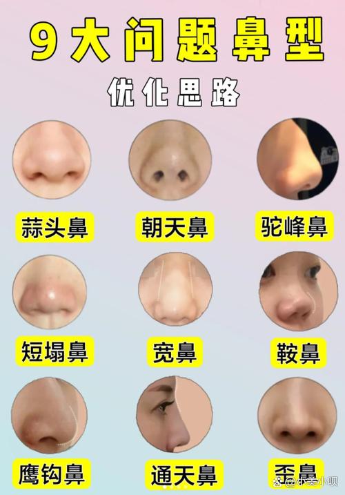 鼻综合是什么意思