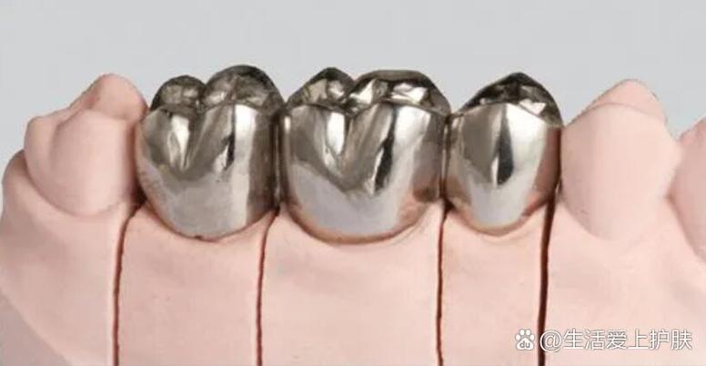 镶牙什么样的好