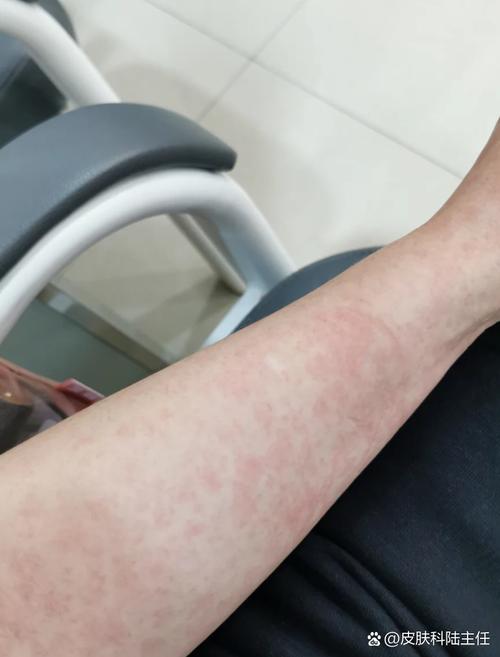 皮肤过敏有什么症状