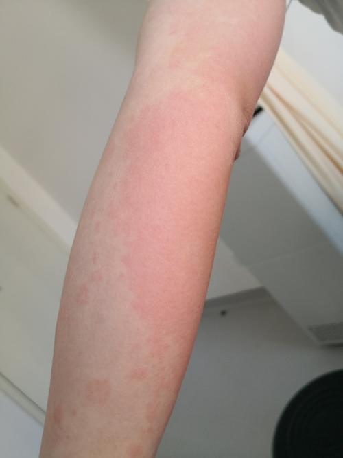 皮肤过敏有什么症状