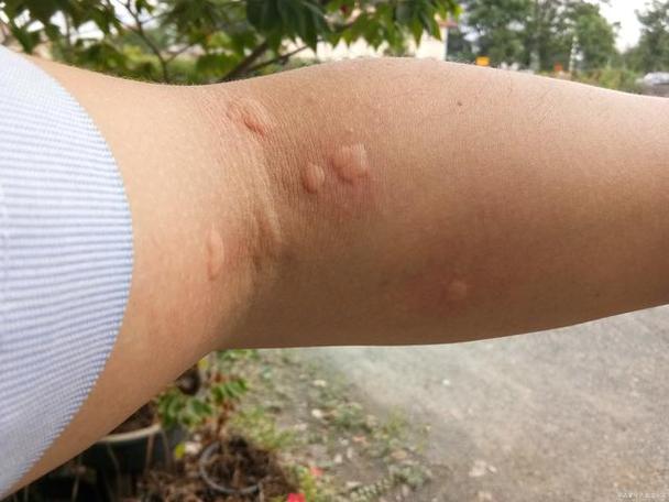 皮肤过敏有什么症状