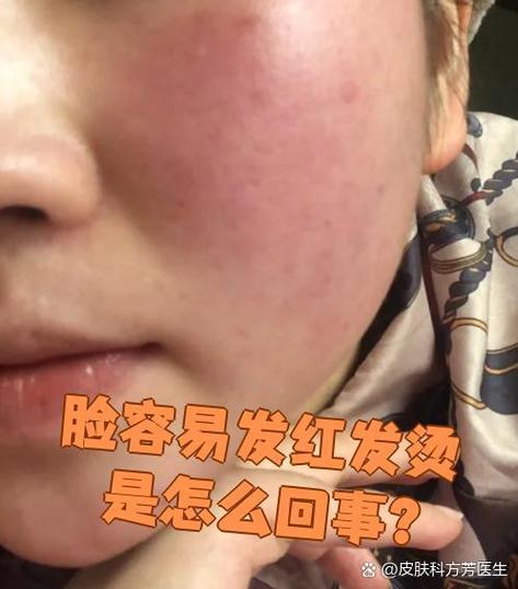 脸为什么会发红发烫