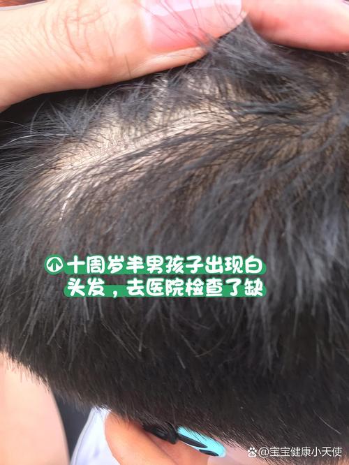 有白头发是缺什么