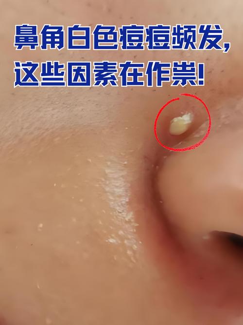 痘痘里的白色是什么