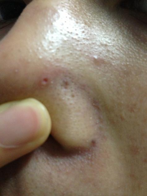 痘痘里的白色是什么