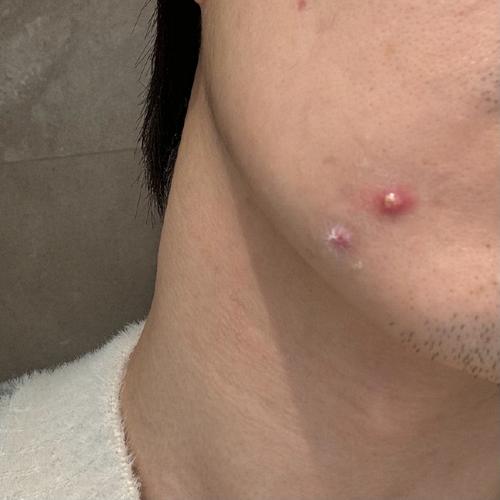 痘痘里的白色是什么