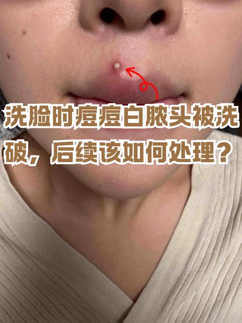 痘痘里白色的是什么