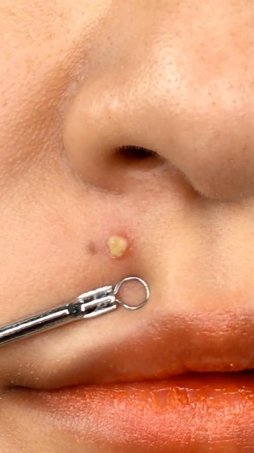 痘痘里白色的是什么