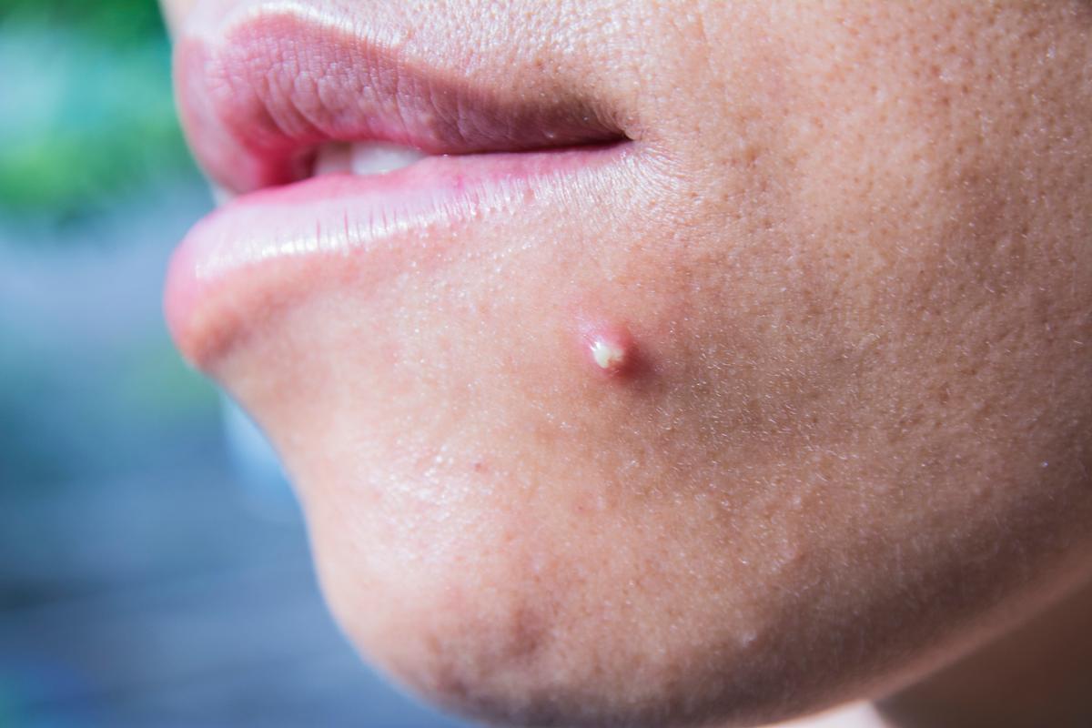 痘痘里白色的是什么