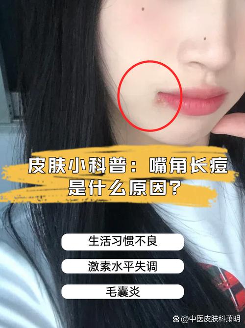 嘴角起痘痘什么原因