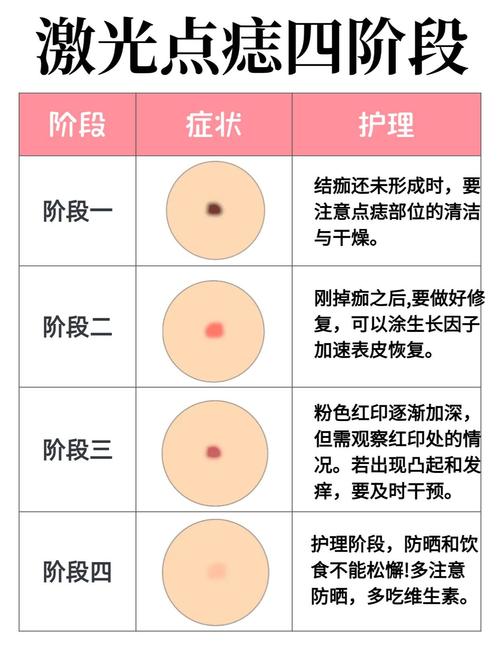 点痣有什么方法