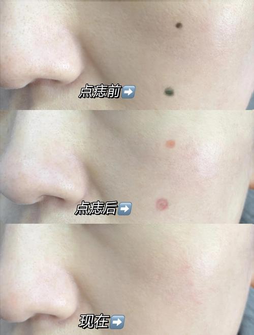 点痣有什么方法