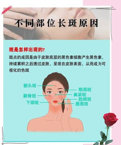 为什么脸上有雀斑
