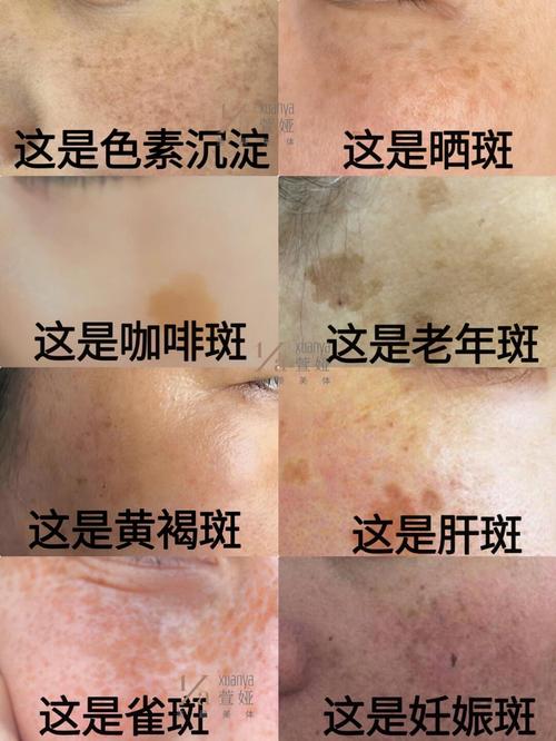 为什么脸上有雀斑