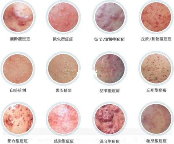 粉刺为什么会疼