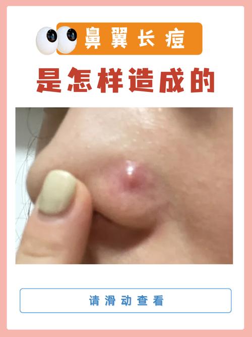 粉刺为什么会疼