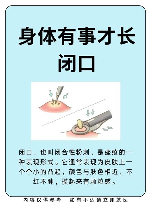 粉刺为什么会疼