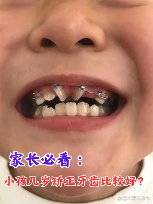 什么年龄矫正牙齿