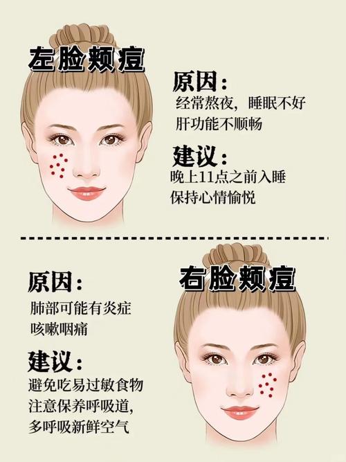 为什么脸上反复长痘