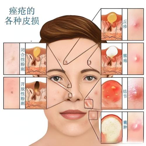 为什么脸上反复长痘