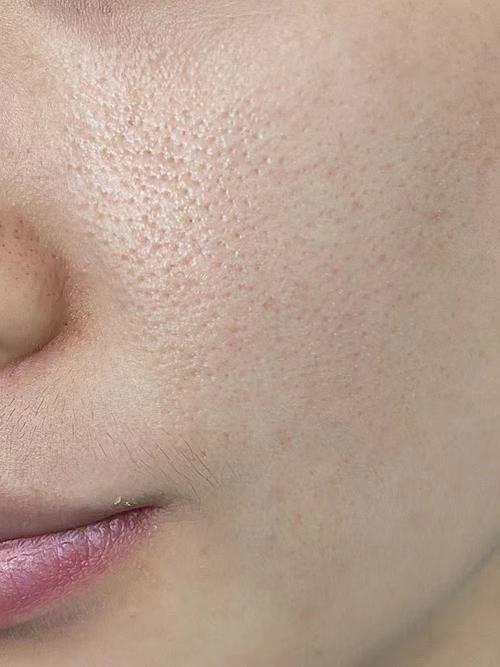 脸上为什么毛孔粗大