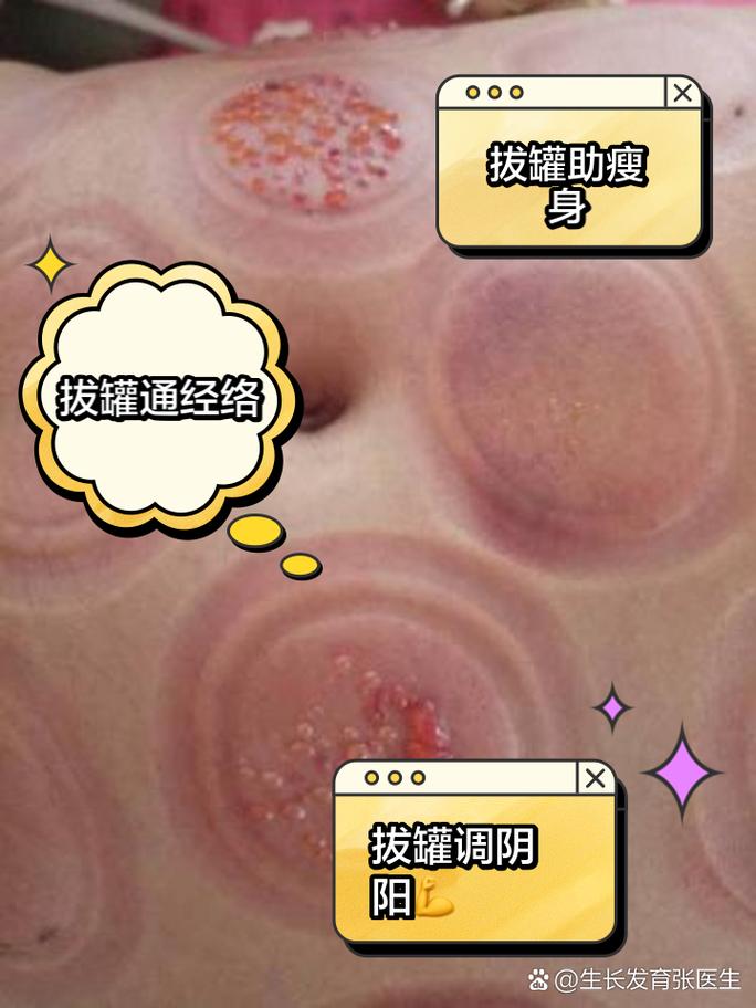 拔罐什么位置可以减肥
