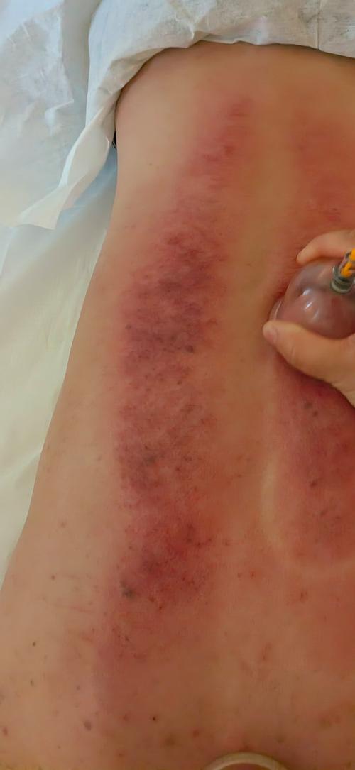 拔罐减肥抹的是什么感觉