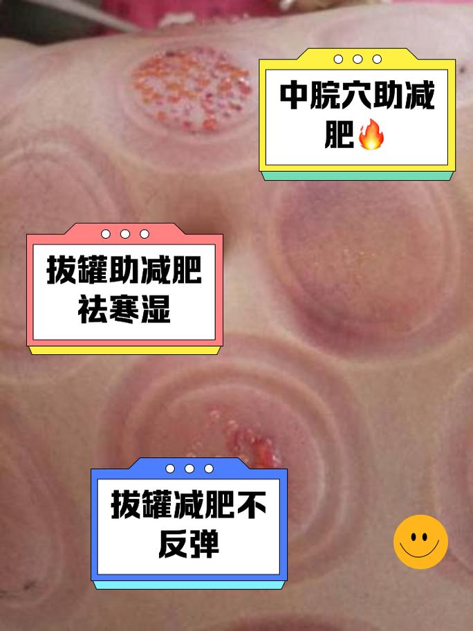 拔罐减肥抹的是什么感觉
