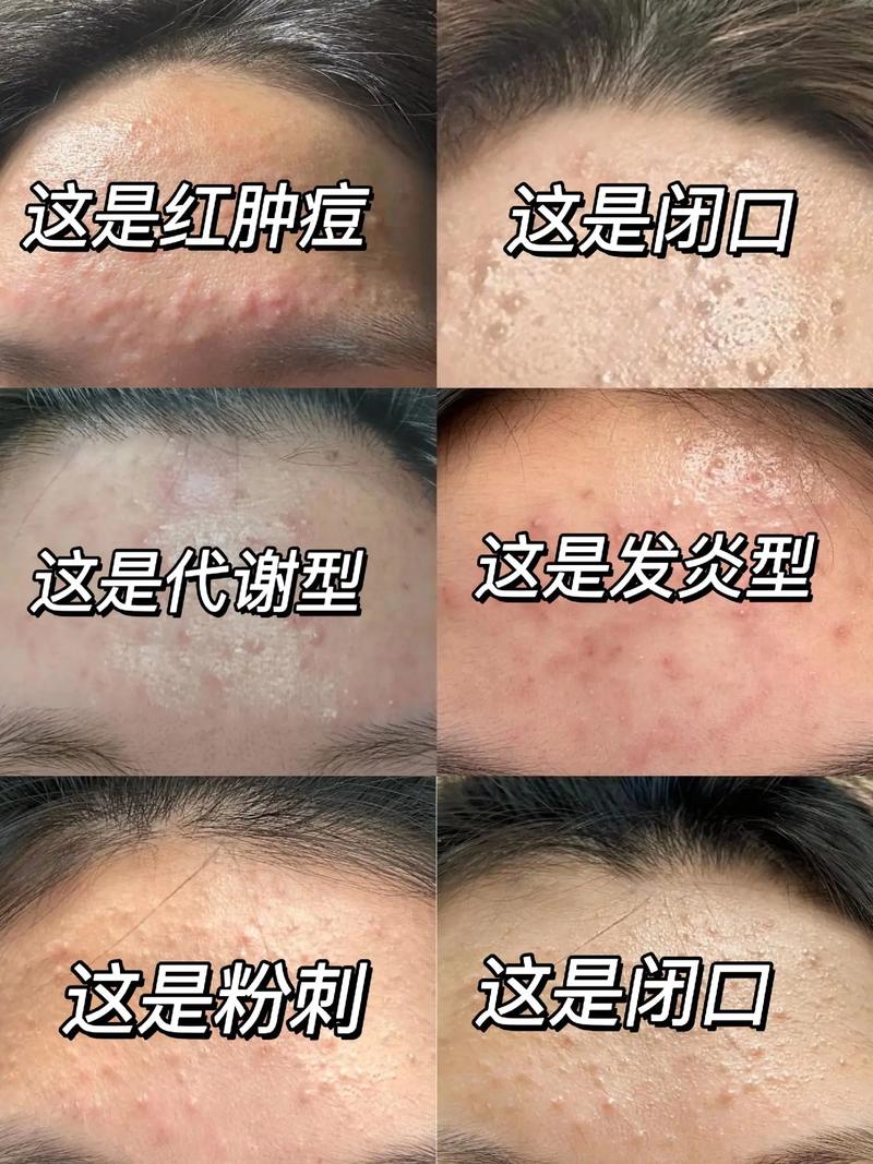 闭口粉刺长什么样